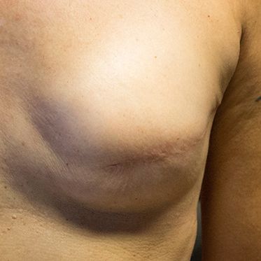 1.Brustkrebstattoo-Tag; vorher; Fru Tattoo, Uelzen; Foto: Shenevra Punk Pics